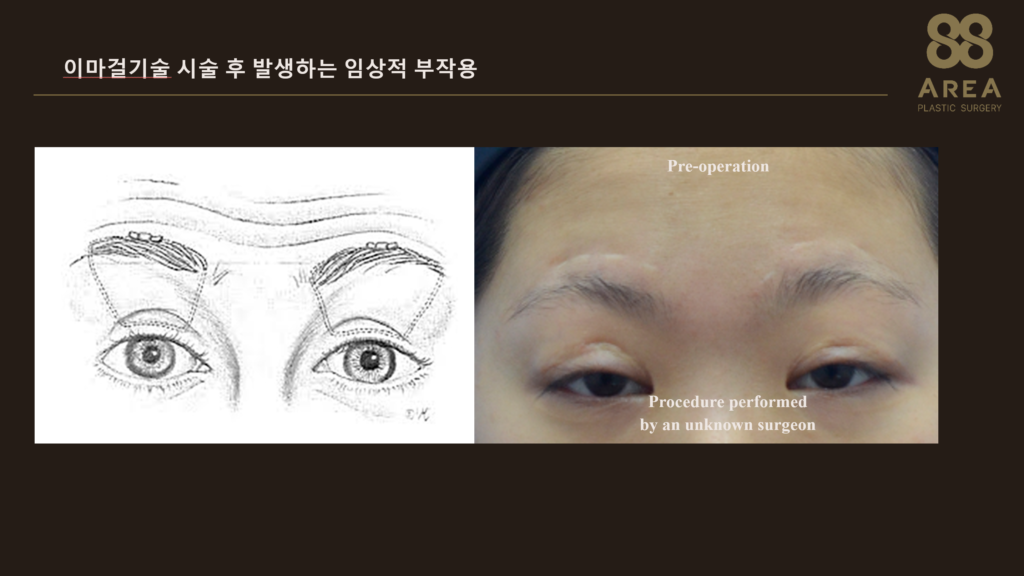 이마걸기술을 이용한 안검하수 교정 방법과 수술 전 안검하수 모습