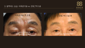 고도안검하수 재수술 공통근막 수술법과 이마걸기술 비교