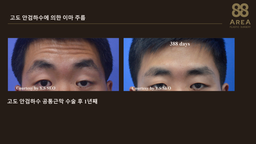 고도 안검하수로 인한 이마주름 원인 공통근막 수술 교정 전후