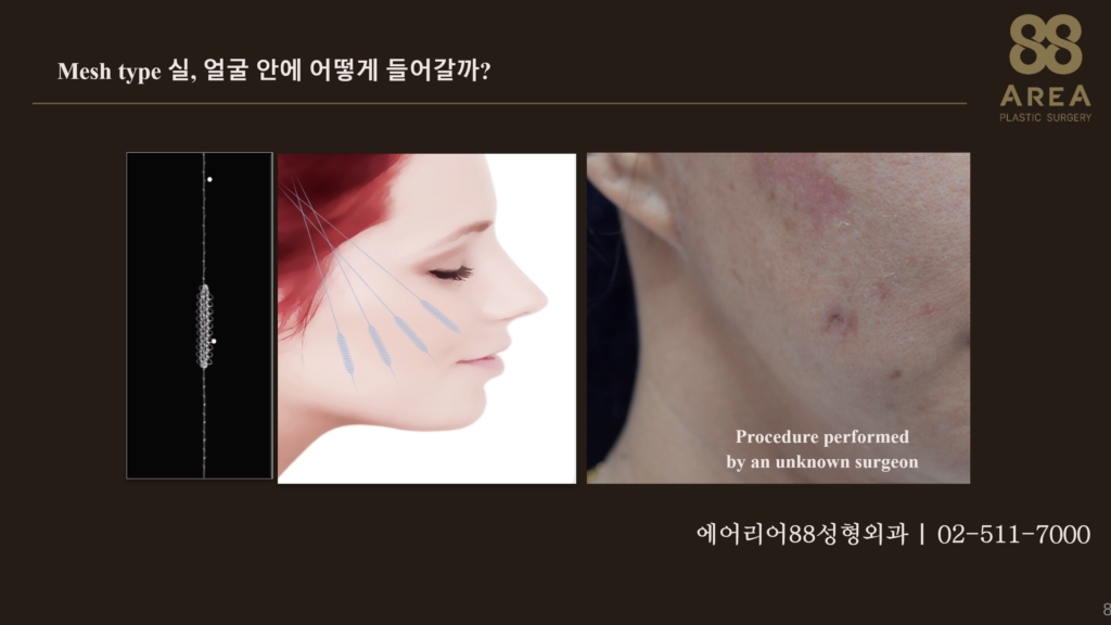 Mesh type 실리프팅의 실 구조와 얼굴 삽입 방향 및 시술 후 피부 변화 사례 | 에어리어88성형외과