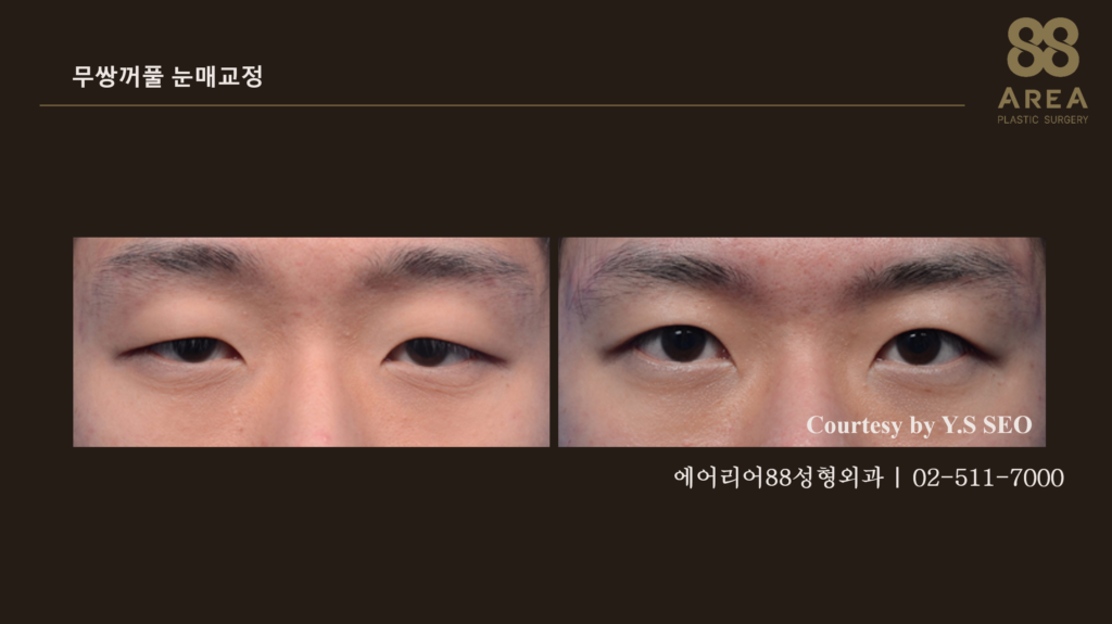 겉으로 드러나는 쌍꺼풀 라인을 크게 만들지 않고 눈 뜨는 기능을 교정한 무쌍꺼풀 눈매교정 전후 비교 사진 | 에어리어88성형외과