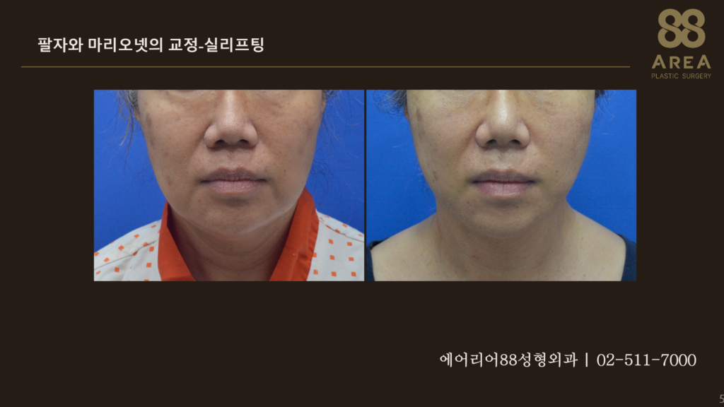 실리프팅 전후 팔자주름과 마리오네트라인 변화를 비교한 정면 얼굴 사진