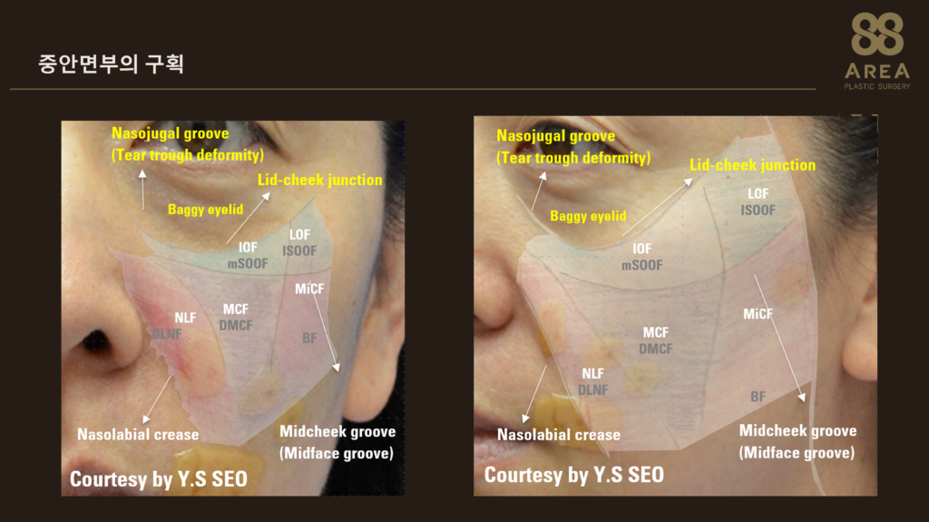 중안면부 거상 계획에 중요한 얼굴 지방구획과 눈밑고랑, Lid-cheek junction, 인디언주름 및 팔자주름