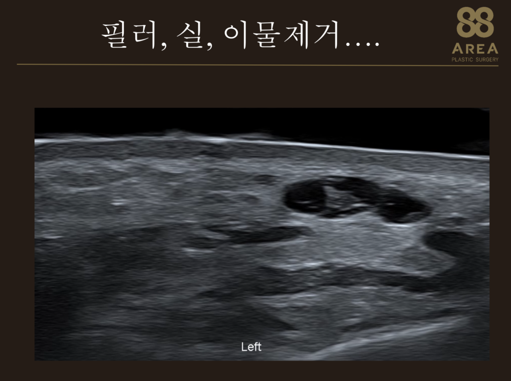 필러 부작용 글에서 필러·실·이물 제거 이력을 설명하는 초음파 영상