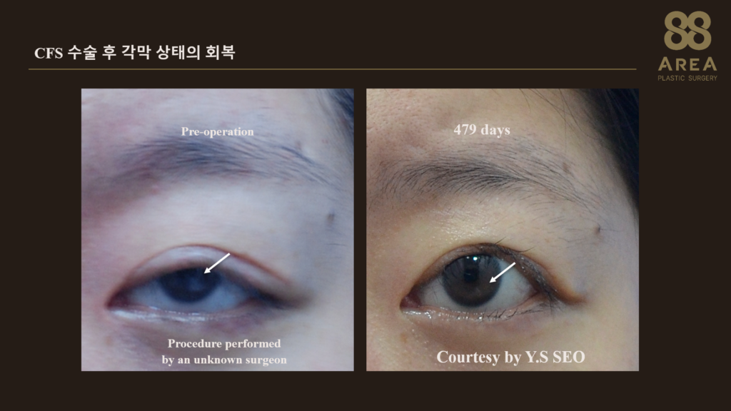CFS 공통근막 수술 전 각막혼탁과 수술 479일 후 각막 상태가 호전된 모습을 비교한 사진