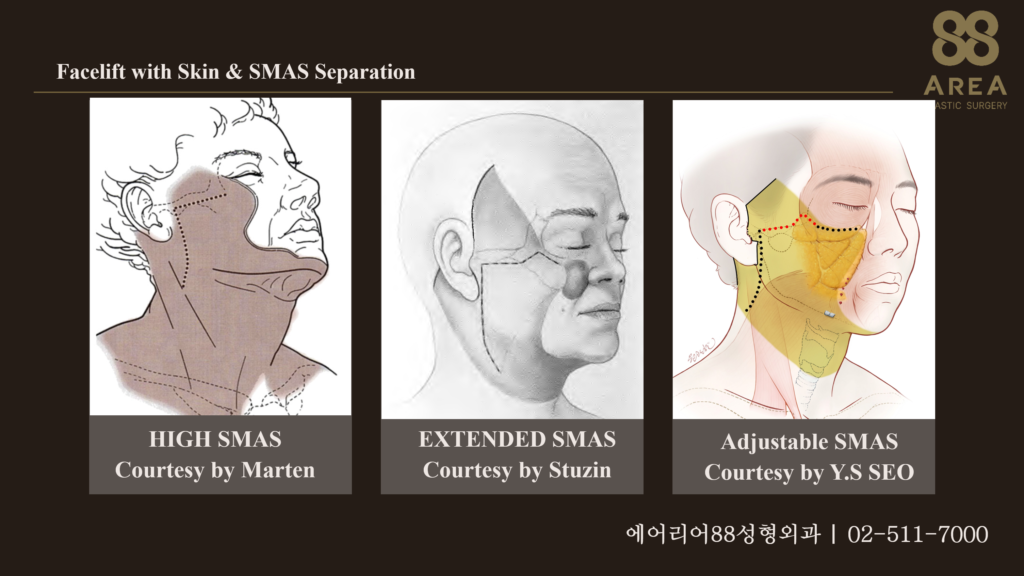 피부와 SMAS를 분리하는 High SMAS, Extended SMAS, Adjustable SMAS의 박리 및 수술 범위를 비교한 해부학 그림