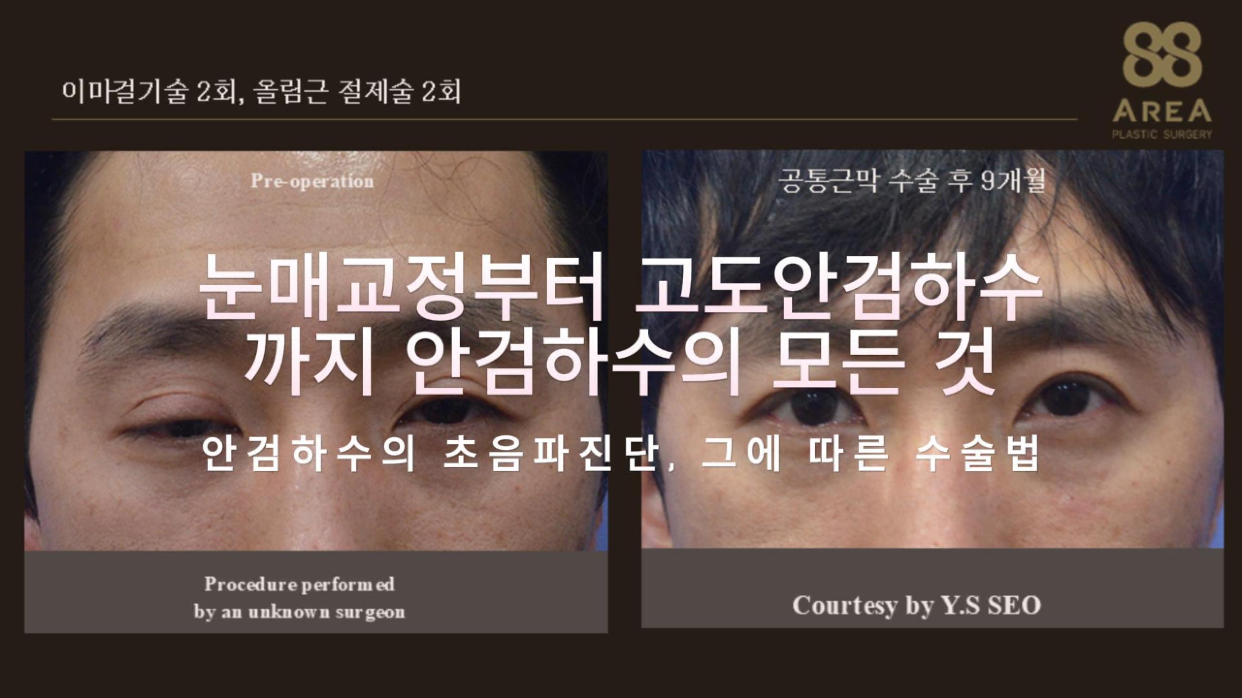 에어리어88성형외과 서의석 원장의 초음파 진단을 통한 눈매교정부터 고도안검하수까지의 종류별 수술법 및 공통근막 교정 수술 전후 비교 이미지