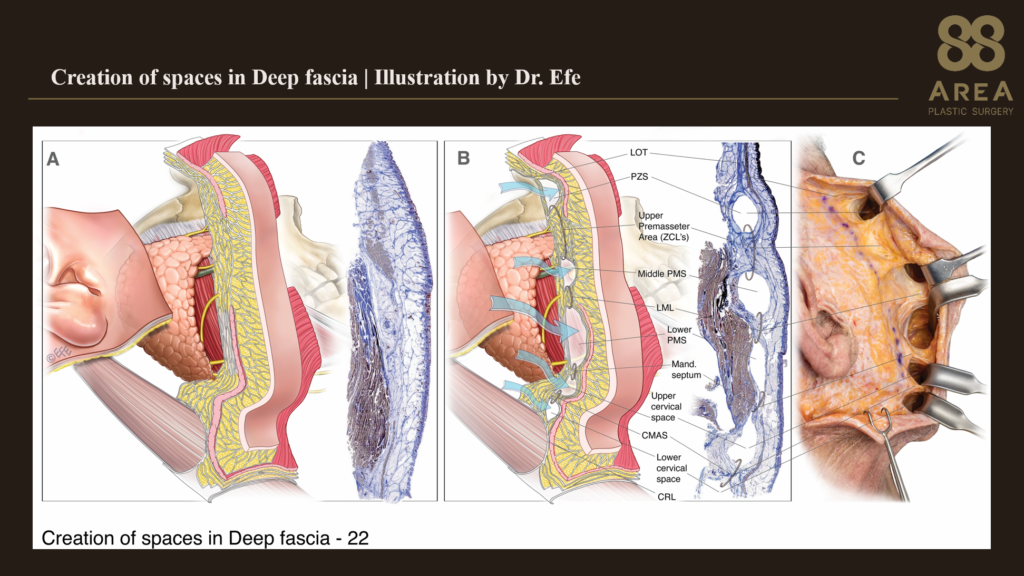 Dr. Efe가 제작한 심부 근막의 해부학적 공간과 목의 근막층, 조직 절편 및 카데바 해부 비교 그림제목