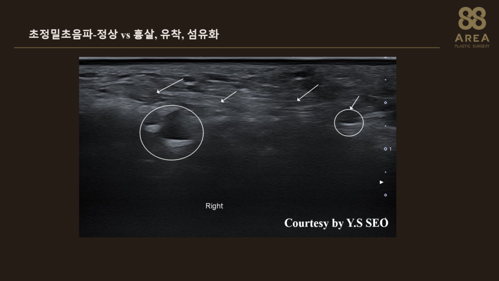 얼굴 연부조직의 흉살·유착·섬유화와 만성염증이 의심되는 부위를 비교해 보여주는 초정밀 고주파 초음파 영상
